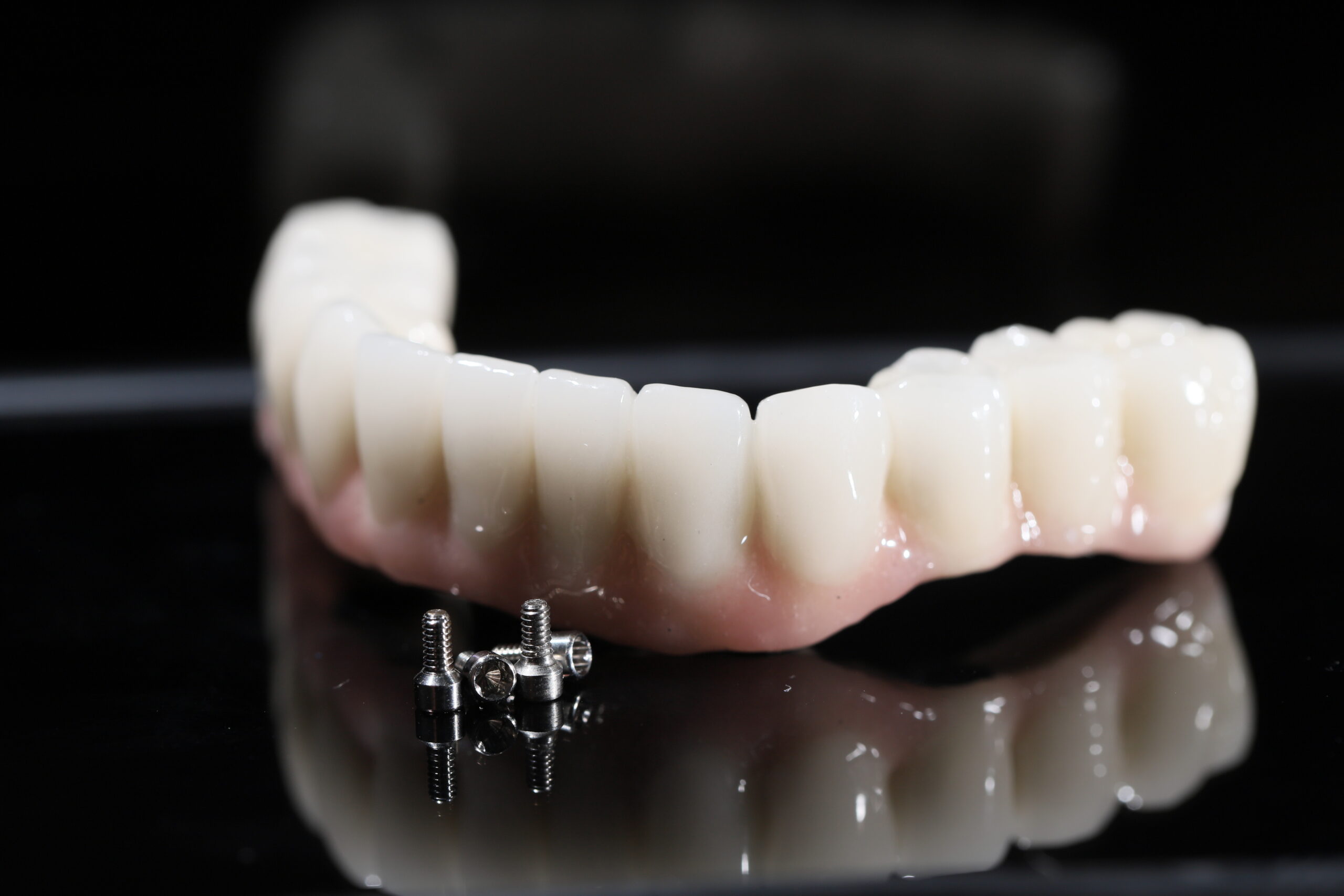 All-on-X Implants: Complete Smile Transformation
