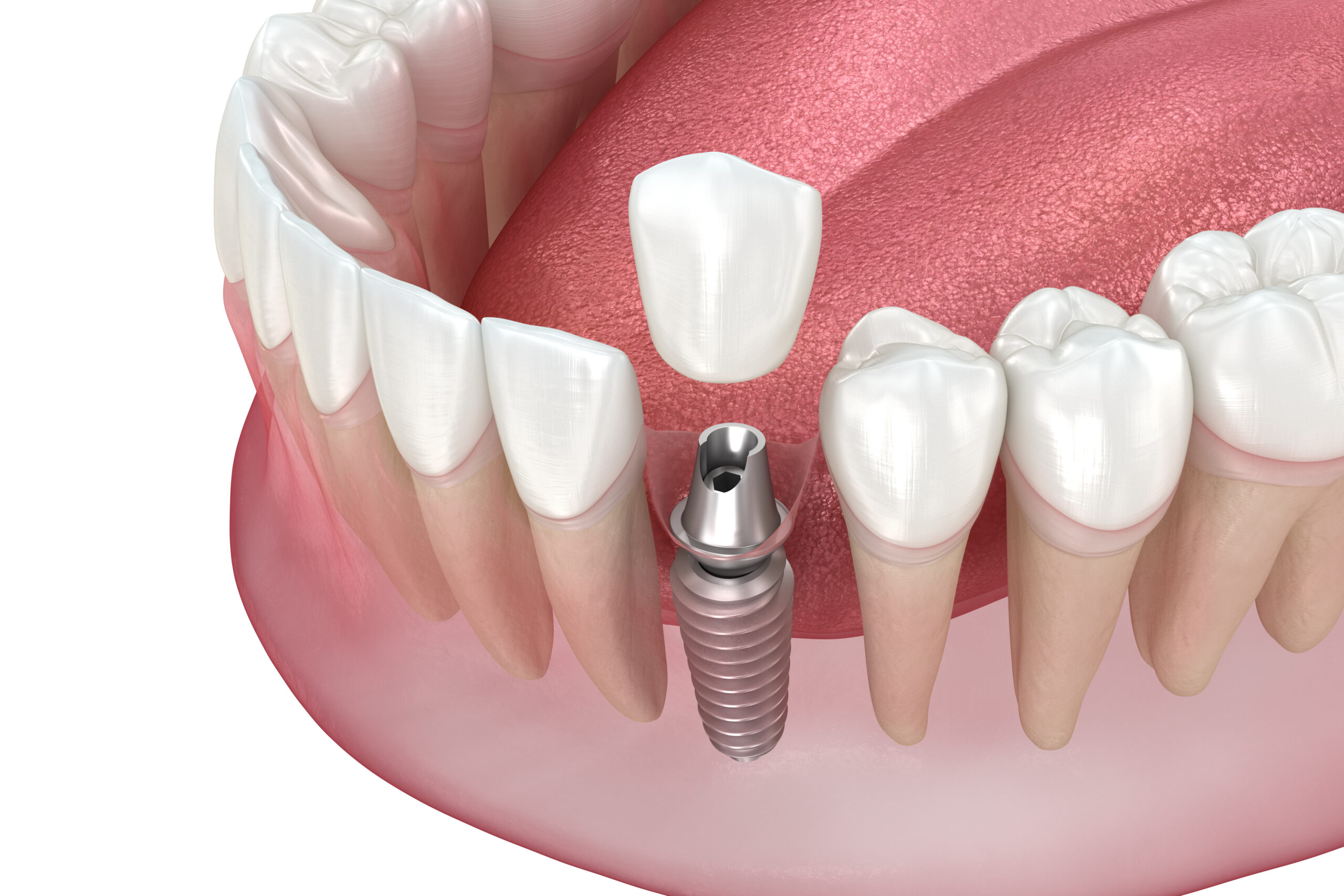 Single Tooth Implants: Natural-Looking Replacements