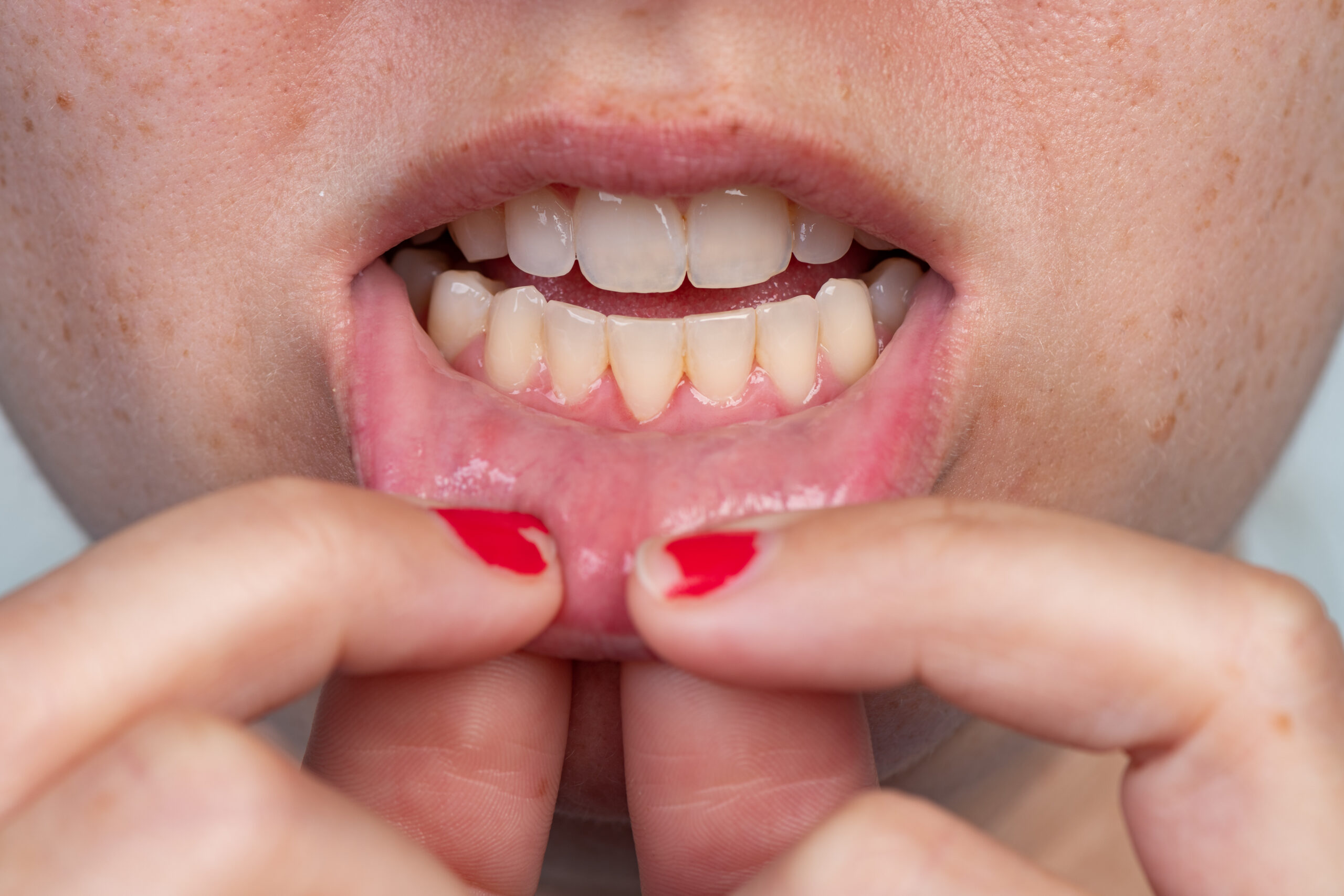 Lingual Frenectomy: Tongue-Tie Release