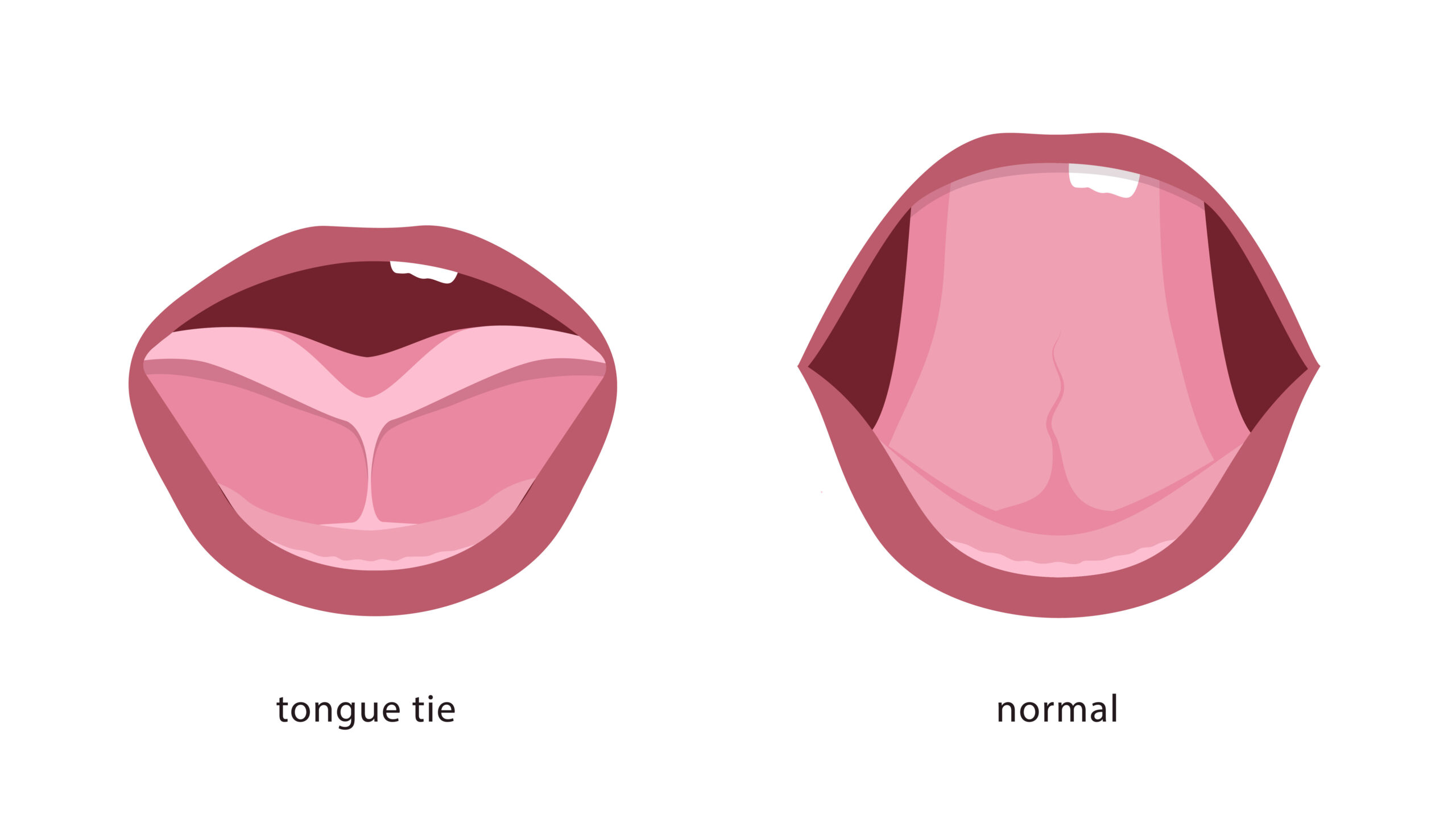 Labial Frenectomy: Lip-Tie Correction