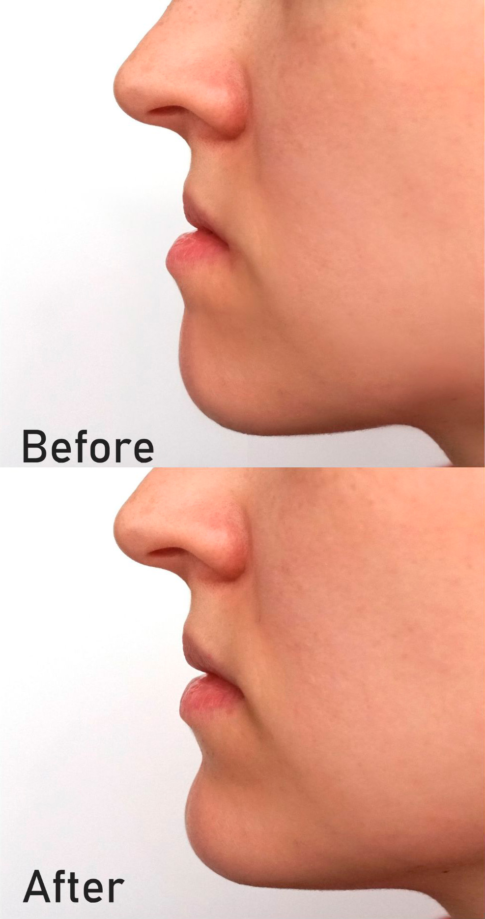 Understanding Orthognathic Surgery